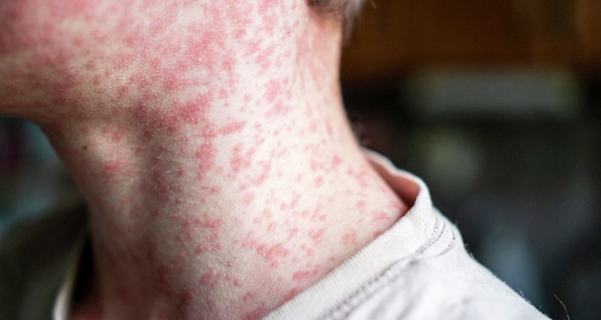 Texas city's first 2026 measles case comes amid hantavirus talk
