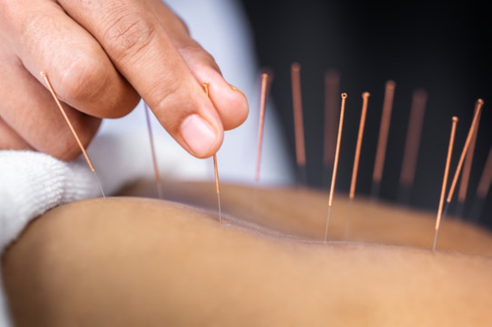 acupuncture needles in a back
