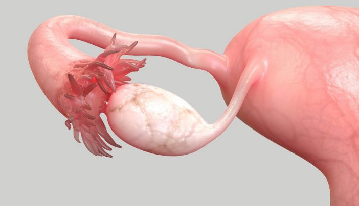 Should you have your fallopian tubes removed to prevent ovarian cancer?