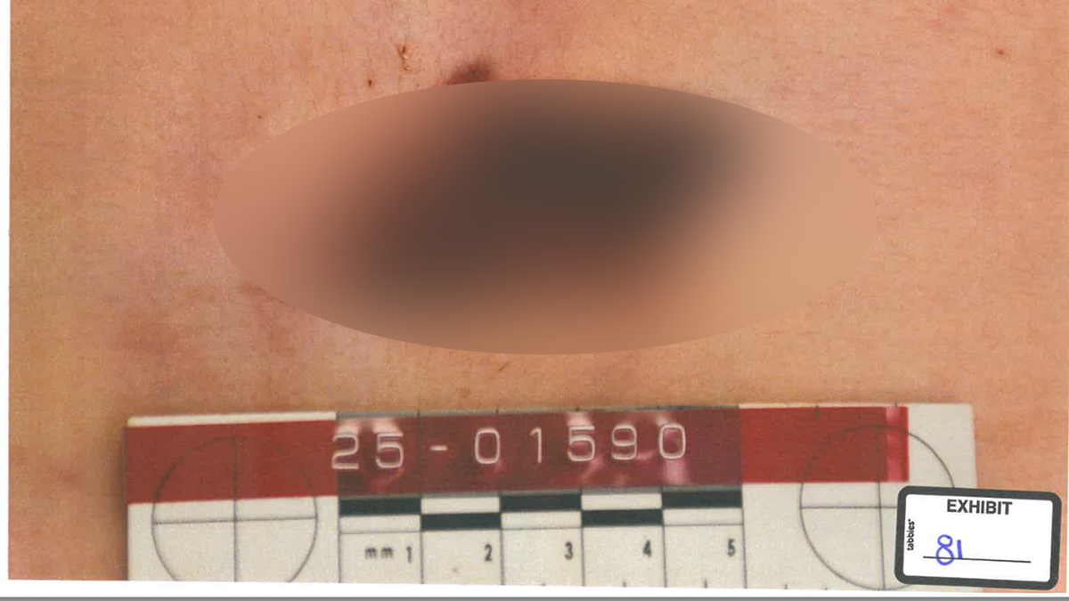 A forensic evidence photograph shows a wound on a person's torso, with the injury area obscured and a measurement scale placed below it.