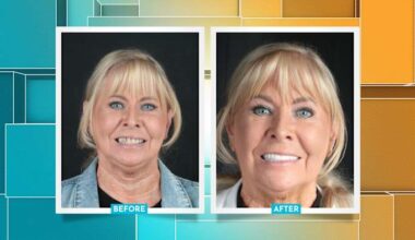When a smile needs more than veneers: one Houston patient’s transformation