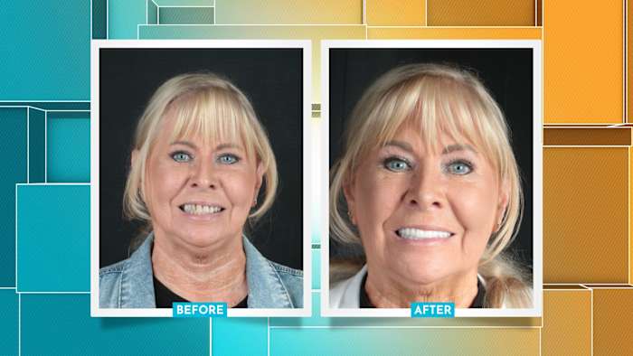 When a smile needs more than veneers: one Houston patient’s transformation