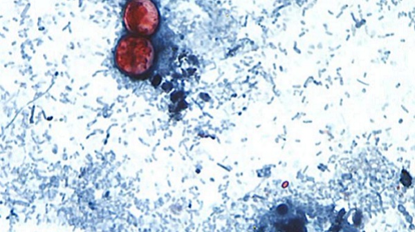 Most healthy people will eventually recover from cyclosporiasis without treatment although their illness may be prolonged.