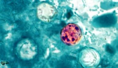 Texas reports more cyclospora cases, still low compared to some states