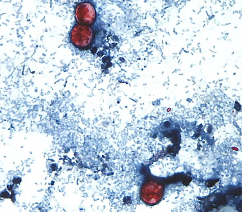 This undated photo taken through a microscope provided by the Centers for Disease Control shows cyclospora cayetanensis oocysts found in a fresh stool sample which had been prepared with a formalin solution and stained with safranin.