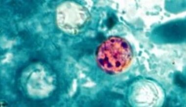 What Is Cyclospora And Why Does Texas See So Many Cases