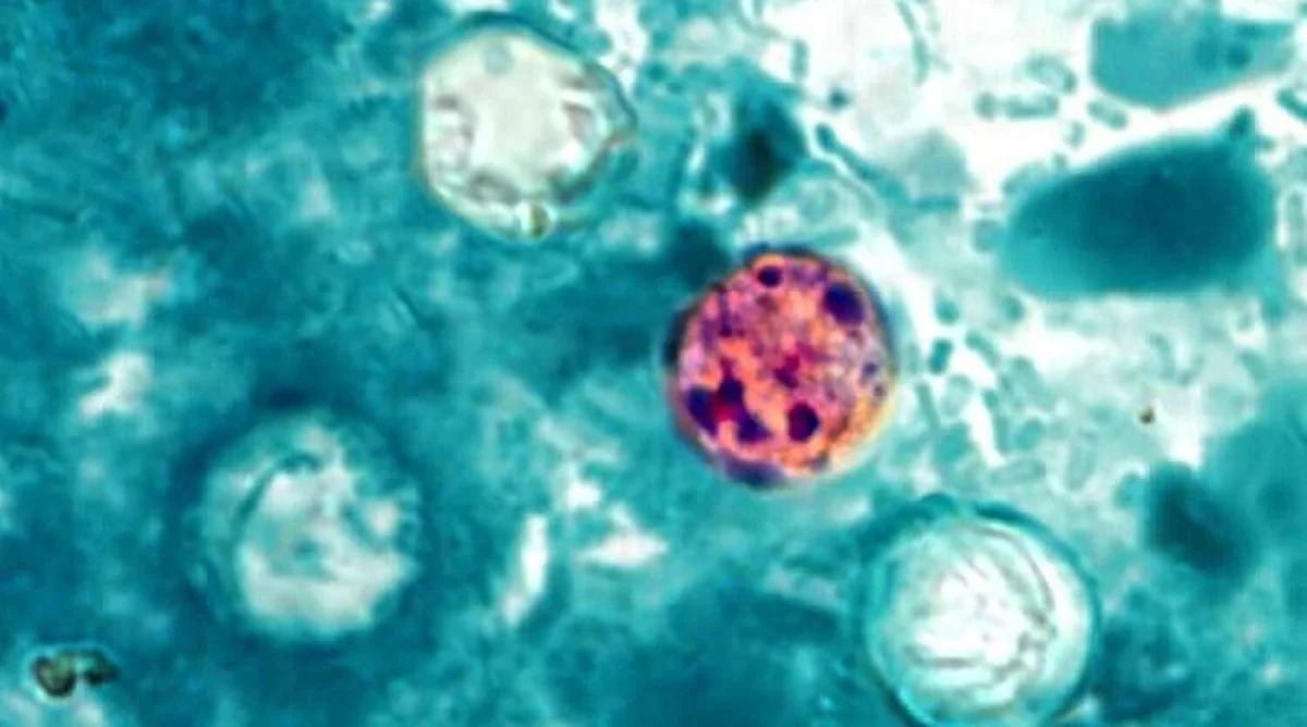 Texas has now reported more than 100 cyclospora cases, still low compared to outbreak states