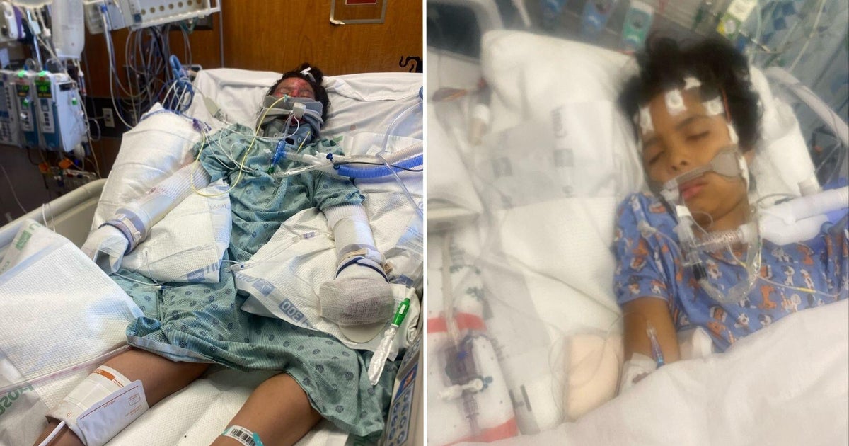 Two siblings remain in burn unit after Fort Worth fire that killed 5-year-old brother