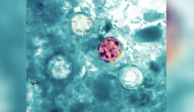 Cyclospora cases spike in Corpus Christi this summer