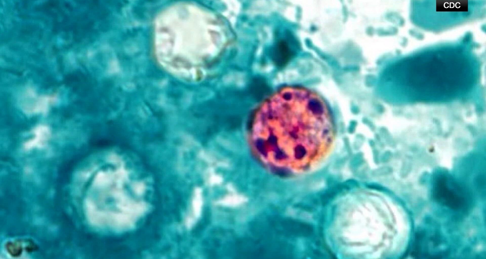 New Cyclospora numbers released for Texas, including North Texas counties