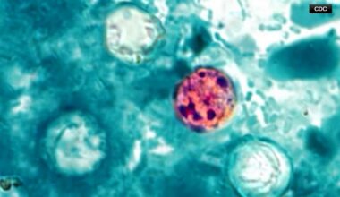 New Cyclospora numbers released for Texas, including North Texas counties