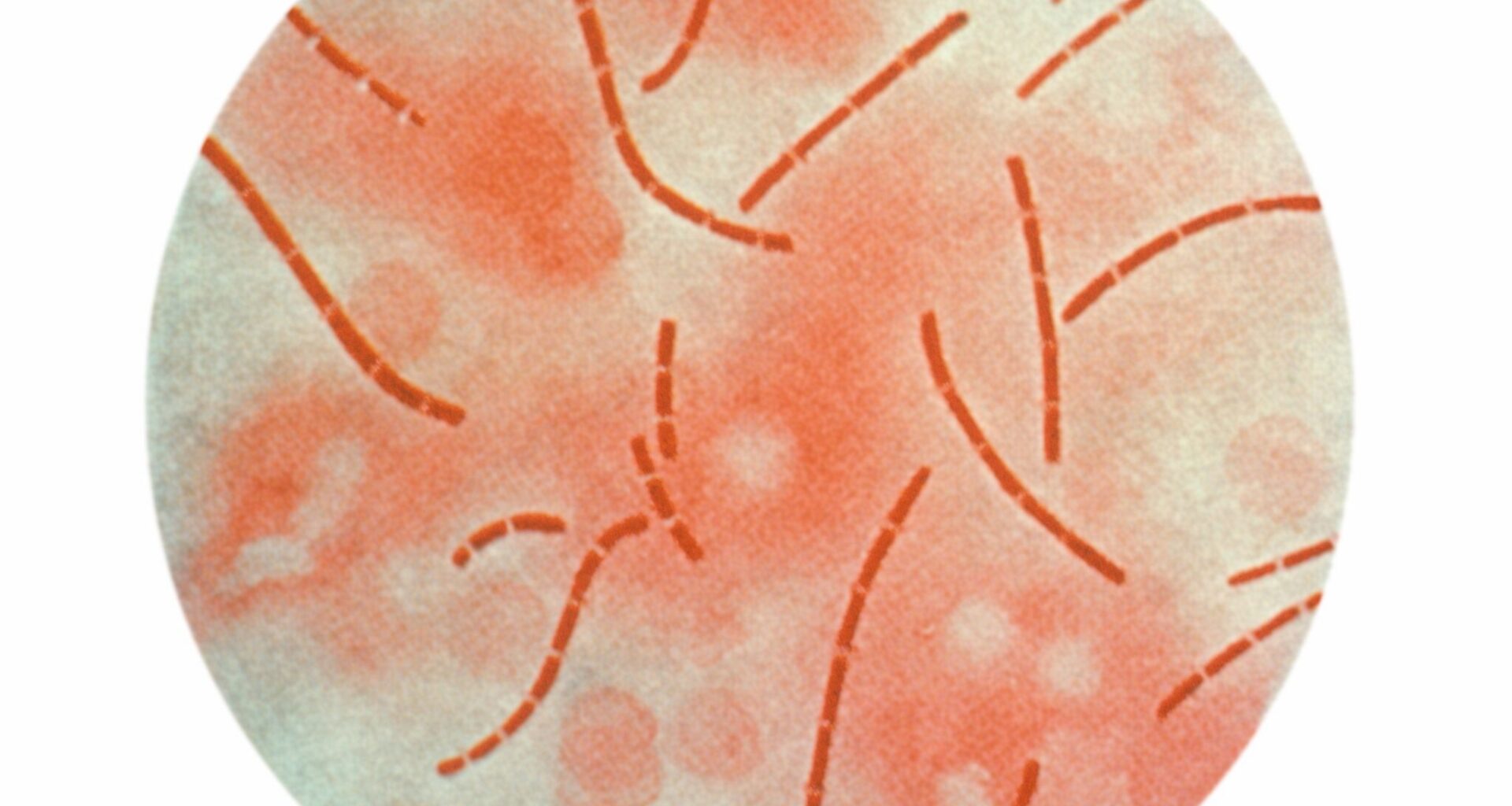 Anthrax case detected in Texas’ so-called ‘anthrax triangle’