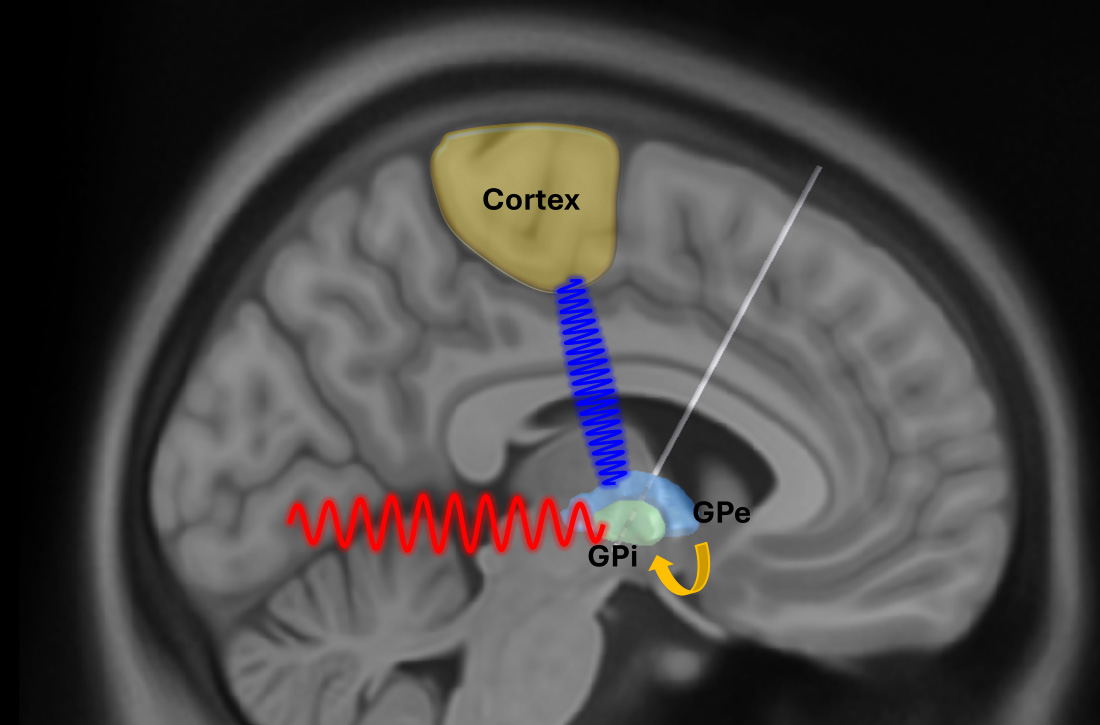 Abnormal brain rhythms may spread through the movement-control network in Parkinson’s disease