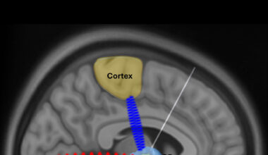 Brain activity discovery could transform Parkinson’s treatment: Newsroom