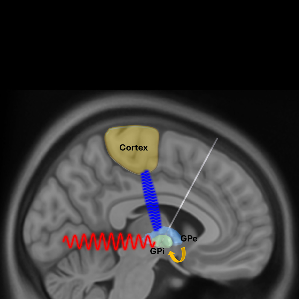 Brain activity discovery could transform Parkinson’s treatment: Newsroom