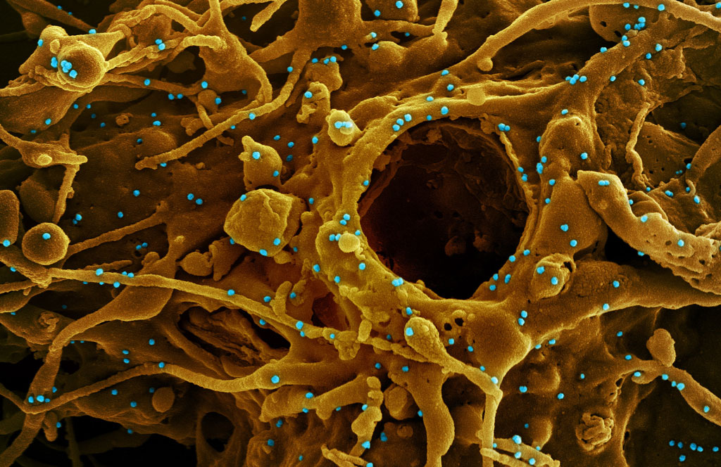A scanning electron microscope image showing a large infected cell with numerous virus particles emerging from its surface. The cell displays extensive branching, filament-like projections extending outward. Multiple round virus particles are scattered across the cell surface and surrounding area, illustrating active viral budding and release.