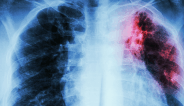 Dallas County probes possible TB exposure at Irving high school