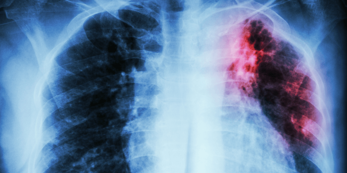 Dallas County probes possible TB exposure at Irving high school