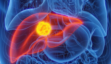 New framework developed for treating liver cancer: Newsroom