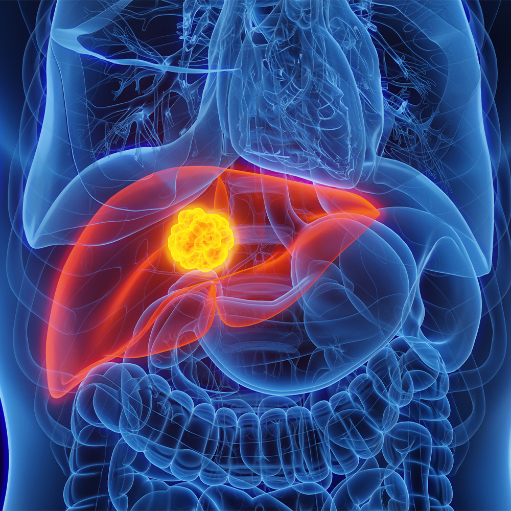 New framework developed for treating liver cancer: Newsroom