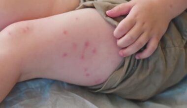 Dallas County measles case prompts North Texas exposure warning