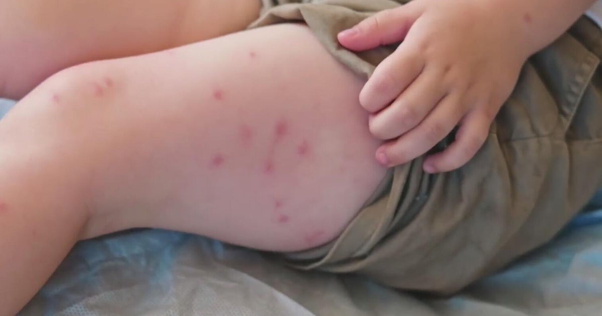 Dallas County measles case prompts North Texas exposure warning