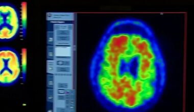 Vaccines may lower alzheimer’s risk by up to 40%, Houston doctor says