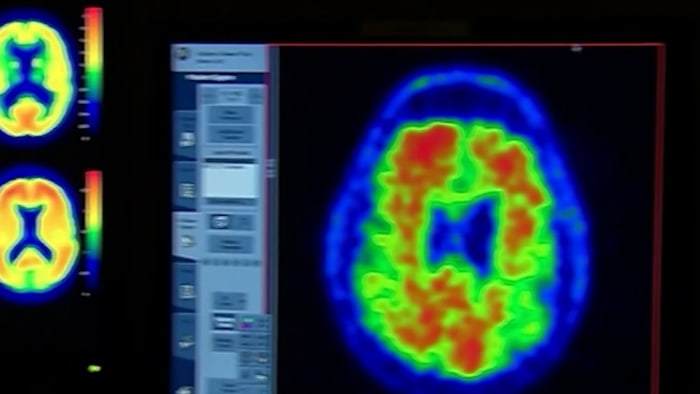 Vaccines may lower alzheimer’s risk by up to 40%, Houston doctor says