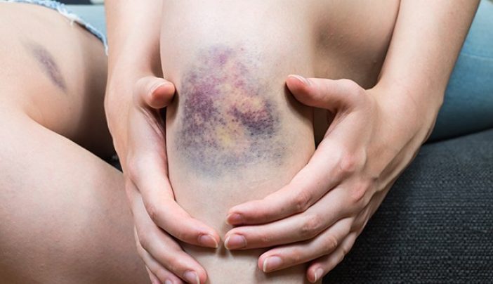 Ecchymosis: 7 things to know about bruising and cancer