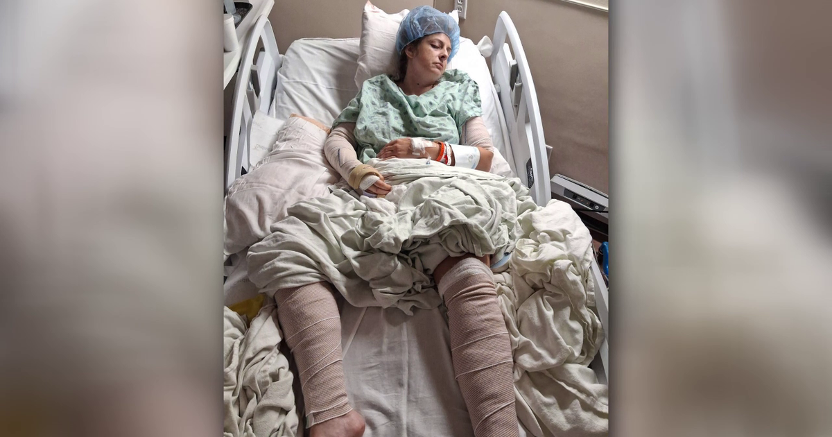 Mother of four hospitalized after dog attack in Polk County