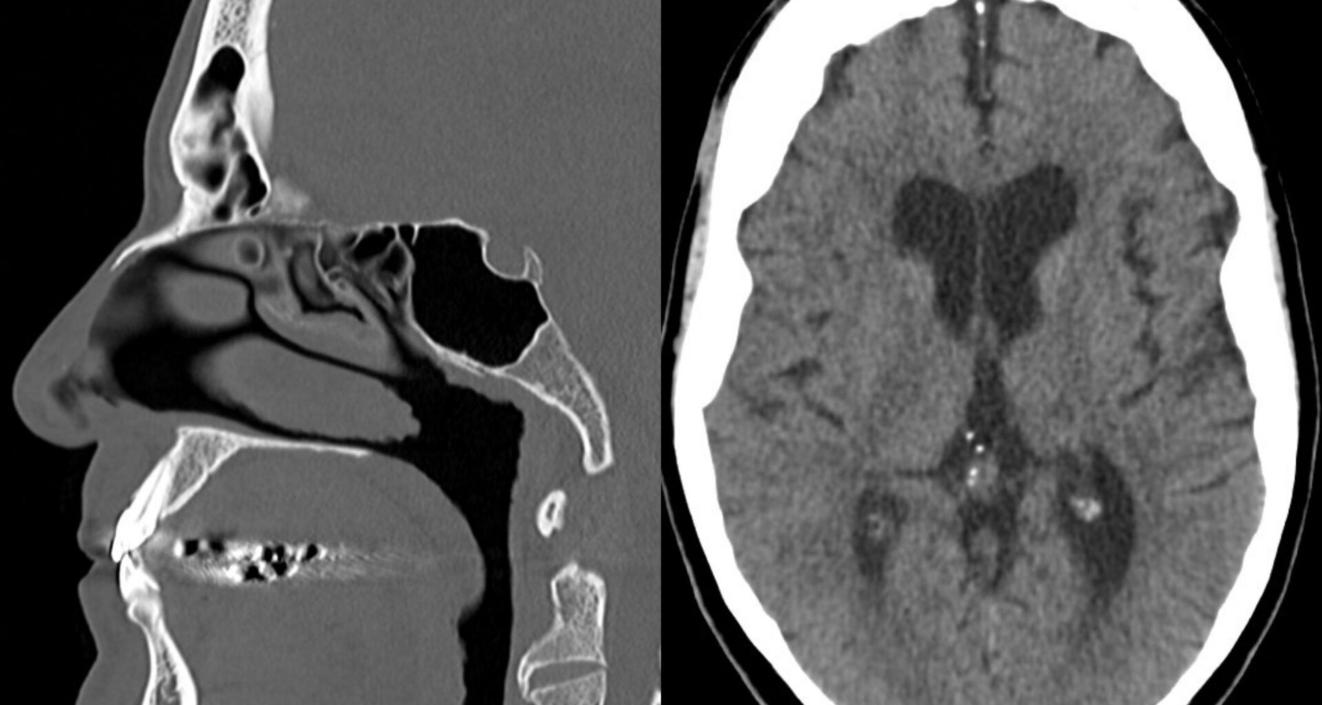 San Antonio researchers use AI to detect brain injuries in veterans