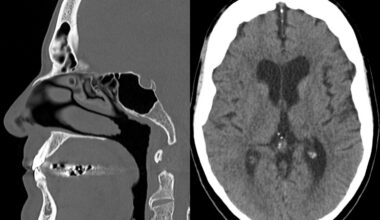 San Antonio researchers use AI to detect brain injuries in veterans