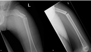Bisphosphonate-Induced Atypical Femoral Fractures in Pediatric Patients With Lipoprotein Receptor-Related Protein 5 (LRP5) Gene Mutation: A Case Report of Twin Patients