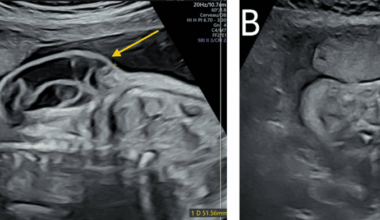 Exploring Prenatal Signs of Congenital Lipomatous Overgrowth, Vascular Malformations, Epidermal Nevi, and Skeletal Anomalies (CLOVES) Syndrome: A Case Report and Literature Review