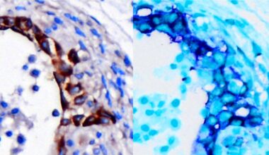 Gene Signature an Early Warning System for Aggressive Pancreatic Cancer, Study Finds