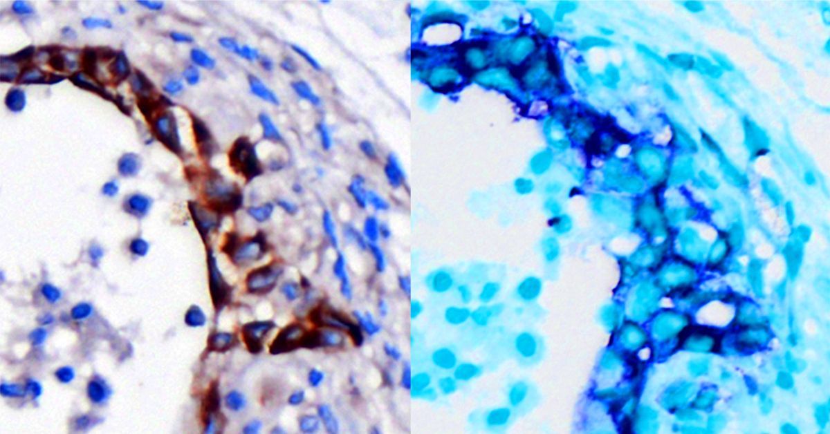 Gene Signature an Early Warning System for Aggressive Pancreatic Cancer, Study Finds