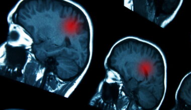 Markey researchers identify genetic marker that could guide brain cancer treatment