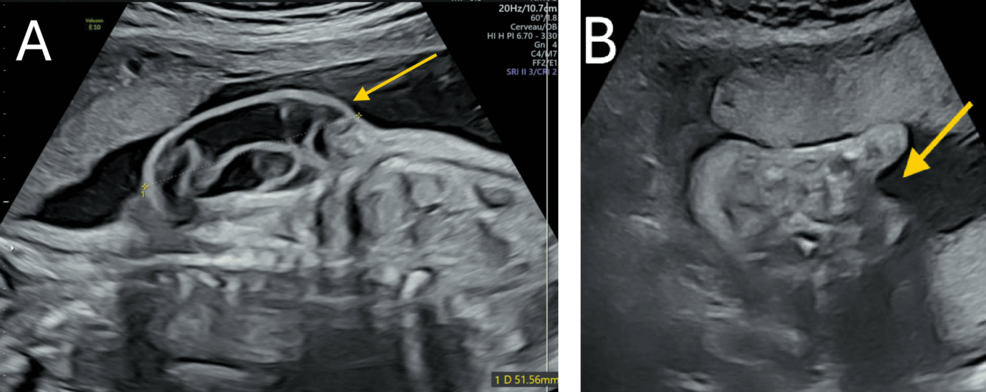 Exploring Prenatal Signs of Congenital Lipomatous Overgrowth, Vascular Malformations, Epidermal Nevi, and Skeletal Anomalies (CLOVES) Syndrome: A Case Report and Literature Review