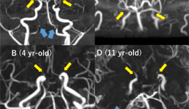 Delayed Diagnosis of Vertebrobasilar Artery Stenosis Developed During Follow-Up of Two Patients With Pediatric-Onset Moyamoya Disease