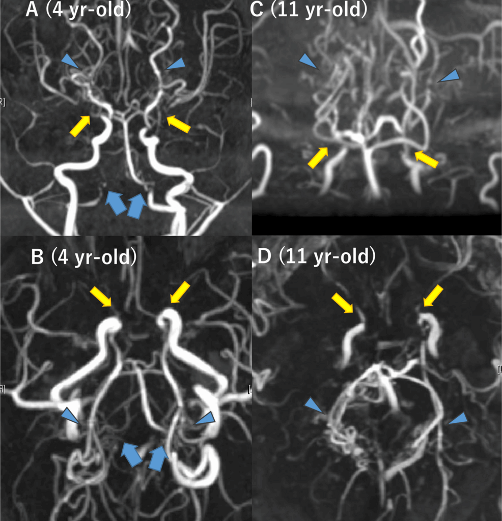 Delayed Diagnosis of Vertebrobasilar Artery Stenosis Developed During Follow-Up of Two Patients With Pediatric-Onset Moyamoya Disease