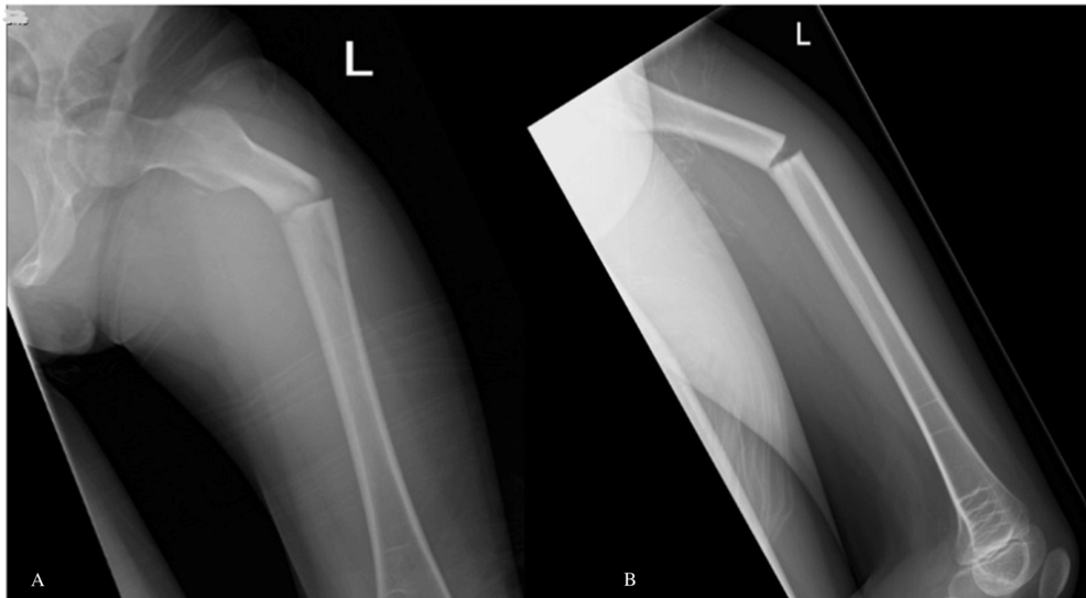 Bisphosphonate-Induced Atypical Femoral Fractures in Pediatric Patients With Lipoprotein Receptor-Related Protein 5 (LRP5) Gene Mutation: A Case Report of Twin Patients