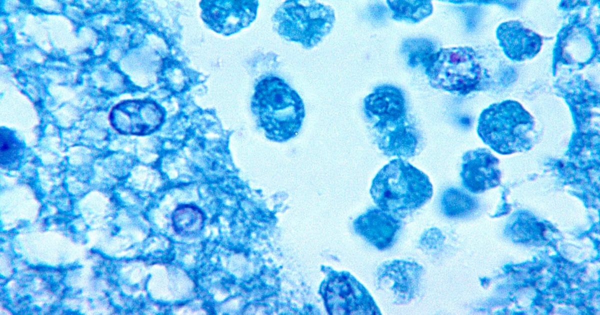 Child dies after contracting brain-eating amoeba, hospital says – WSB-TV Channel 2