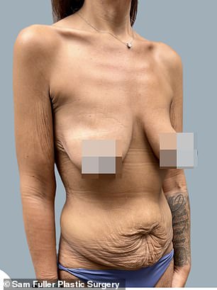 Above is a woman who lost 135lbs after using GLP-1 medication