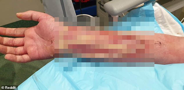 The blurred image shows the man's arm with skin torn away and his tendons showing due to the flesh-eating bacteria