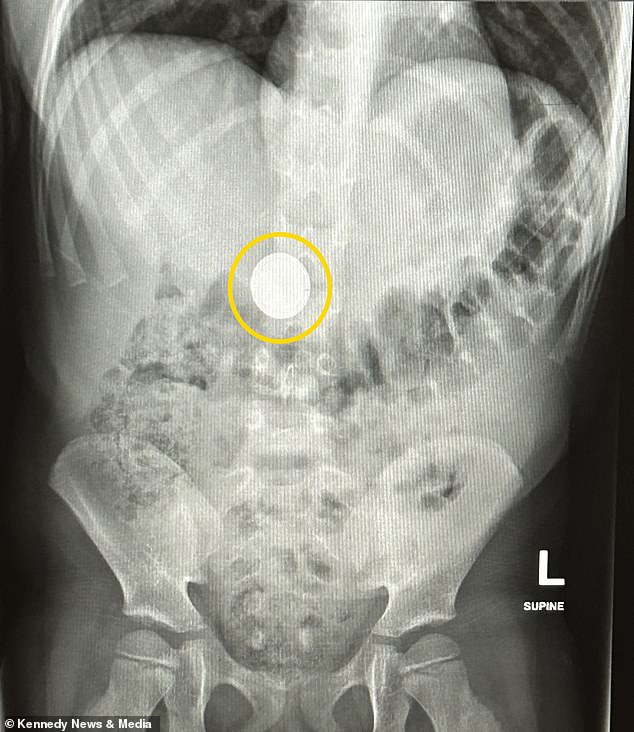 The button battery reached Lily's digestive system. Typically, once inside the esophagus, moisture completes an electrical circuit between the battery’s terminals, triggering a reaction that produces a potent chemical that rapidly burns and dissolves surrounding tissue