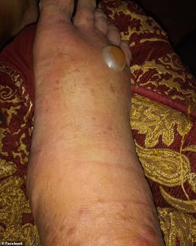 After Adam Perez stuck his toes into some water at a Corpus Christi park, his foot and leg swelled enormously and a giant blister formed, due to vibriosis