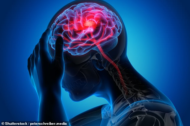 Women who had complicated pregnancies could be more likely to have an early stroke, a study has found. Pictured: Stroke Illustration