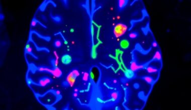 Altered Brain Organoid Neuron Growth in 22q11.2 Deletion