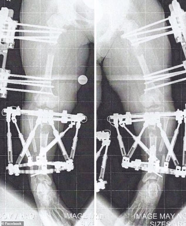 In August 2010, Crews underwent her first of three limb-lengthening procedures. Leg lengthening for dwarfism or bow legs involves surgically cutting the bone and implanting a device (either an external fixator or internal rod)