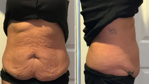 Charmaine Hines @mj_mum_of_3 Two images of a stomach showing loose skin, one photo from the front and one from the side